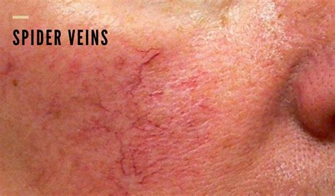 Broken Blood Vessels Around Eyes - Vein Solutions