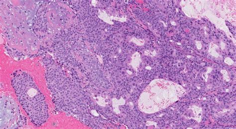 Salivary duct carcinoma | Ottawa Atlas of Pathology