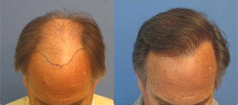 Hair Transplant Los Angeles Cost - Cost of Hair Restoration in Los Angeles