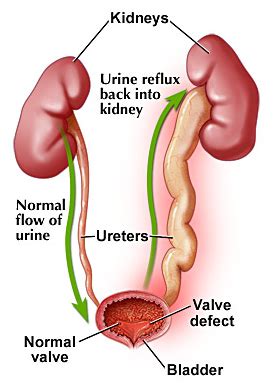 Vesicoureteral reflux — Medlibes: Online Medical Library