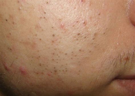 How to Remove Blackheads - Blackheads Home Remedies That Really Work ...