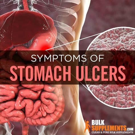 Stomach Ulcers: Causes, Symptoms, Home Remedies & Treatment