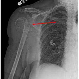 Right upper extremity X-ray depicting a right humeral neck fracture ...