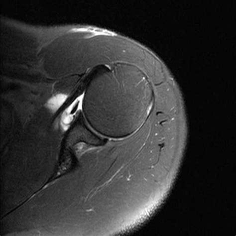 Type 2 SLAP Tear - Body MR Case Studies - CTisus CT Scanning