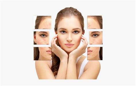 Acne Scars Removal For Women - Salicylic Acid Peel PNG Image ...