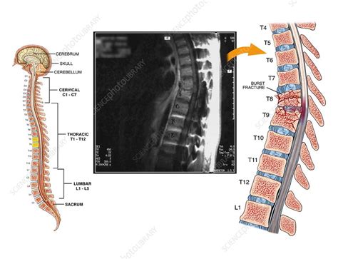 Burst fractures of the thoracic spine - Stock Image C021/0263 - Science Photo Library