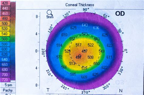 Corneal Pachymetry | Eye Patient