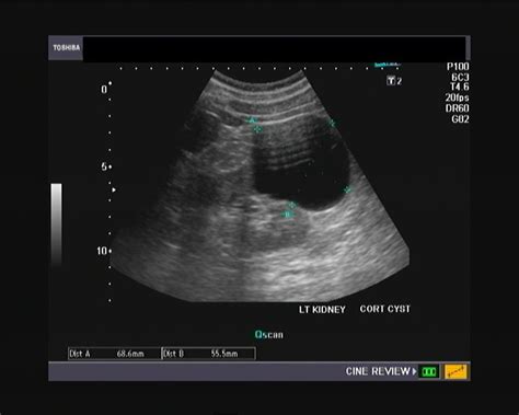 Ultrasound and Color Doppler videos: An Unusual cortical cyst of kidney ...