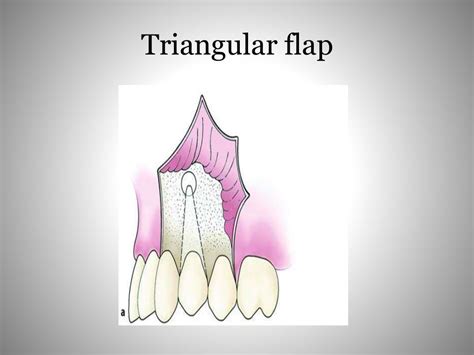 Flaps in oral surgery