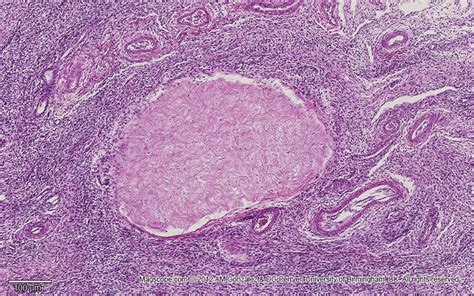 Micrograph of a corpus albicans illustrating its fibrous structure