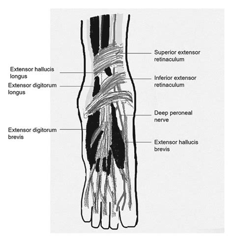 A sketch drawing showing the anatomy of the anterior tarsal tunnel ...