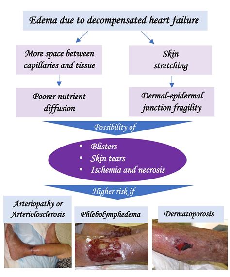 Leg ulcers due to heart failure? - Elena Conde