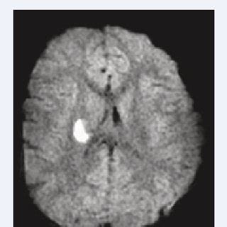 Apparent diffusion coefficient (ADC) MRI image: signal decrease due to... | Download Scientific ...