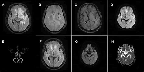 Primary angiitis of the central nervous system – A challenging ...