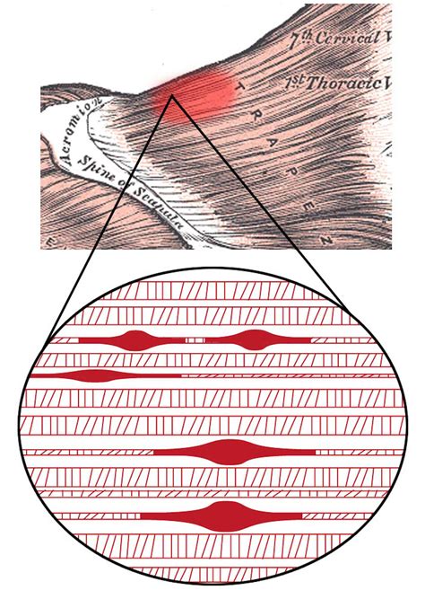 What Are Muscle Knots? An Exercise Physiologist Explains What Those Tight Little Lumps Are And ...