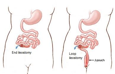 Loop Ileostomy