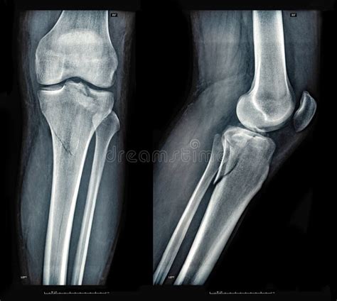 Human Broken Leg X Ray