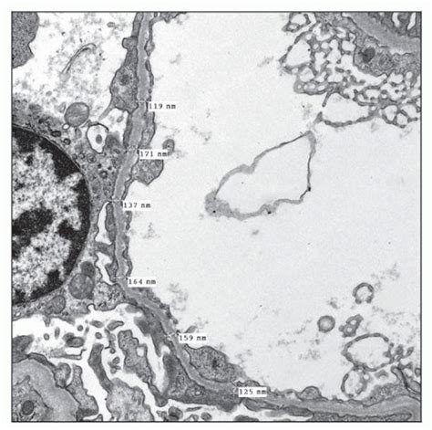 Thin Basement Membrane Disease | Basicmedical Key