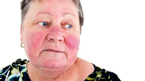 Allergy Trigger: Pictures Of Skin Rashes On Face And Neck