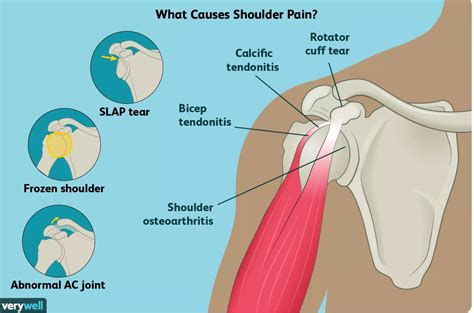 Causes of Shoulder Pain and Treatment Options - Sports Medicine Weekly