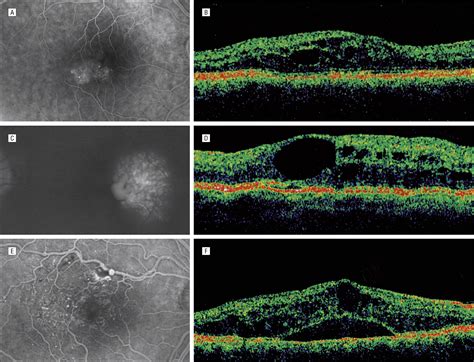 Idiopathic Macular Telangiectasia | Cardiology | JAMA Ophthalmology | JAMA Network