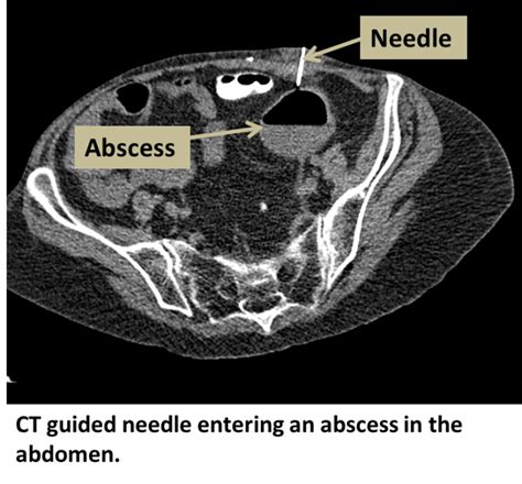 Drainage Percutaneous - Interventional Radiology | UCLA Health