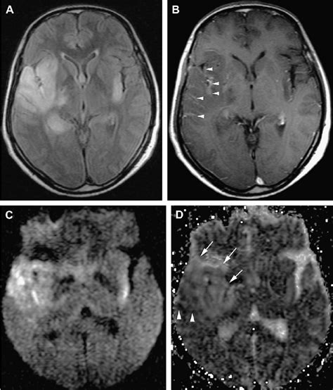 Early HSV-1 encephalitis. Lesions involving the right medial temporal... | Download Scientific ...