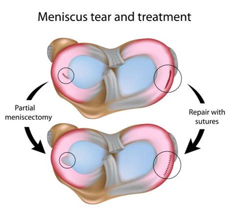 Meniscus tear: Surgery, rehabilitation, costs | Joint-surgeon.com