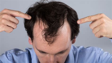 Hair Loss Creates, Signs And Symptoms, Treatments, Grow Brand-new Hair – Educa City