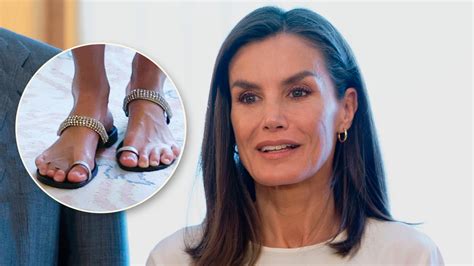 Queen Letizia's Foot Treatment Unveiled: What Is syndactyly?