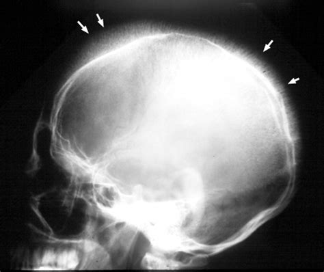 The skull of a bone cancer patient : pics