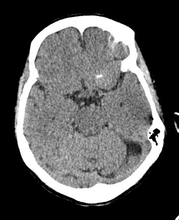 Vertebrobasilar dolichoectasia and incidental meningioma | Radiology Case | Radiopaedia.org