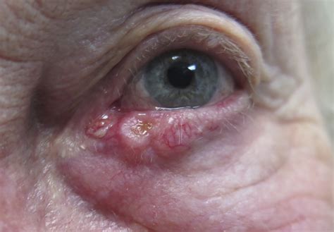 Eyelid Cancers (Malignancies) - Saul Rajak Ophthalmology