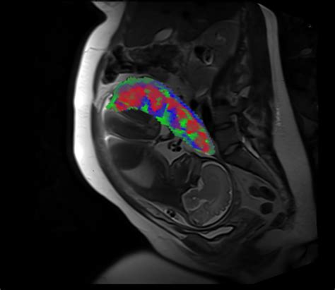 New MRI method provides detailed view of the placenta during pregnancy | National Institutes of ...