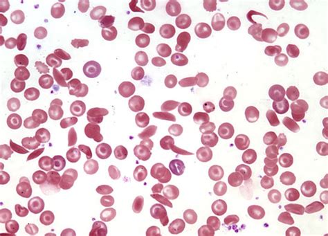 Sickle Cell Anemia Investigation