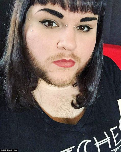 Woman With PCOS Grows A Full Beard After Finding Love With A Model - Trendzified