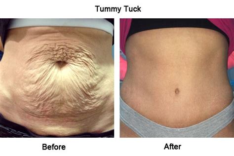 understanding the tummy tuck surgery:- risk, treatment and cost ...