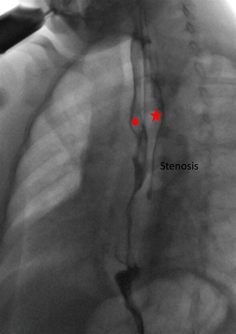 Upper gastrointestinal (GI) contrast study: double lumen extending to... | Download Scientific ...