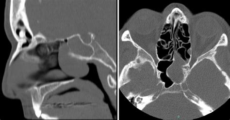 A 55-year-old woman with NGH in the sphenoid sinus: Axial and Sagittal ...