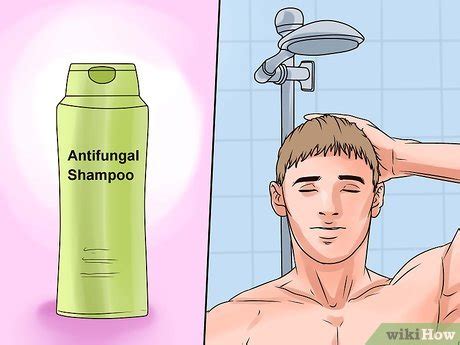 How to Treat Scalp Ringworm: 6 Steps (with Pictures) - wikiHow