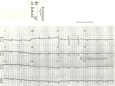 Dextrocardia | ECG Guru - Instructor Resources