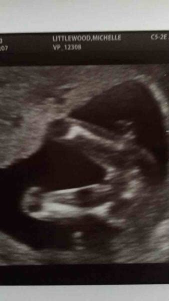 IS 3 LINES ON A ULTRASOUND DEFINATLY A GIRL