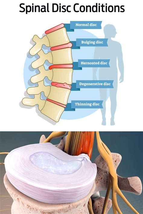 Bulging Disc Symptoms, Treatment, & Pain Relief Options - El Paso, TX | Sciatica Pain and ...