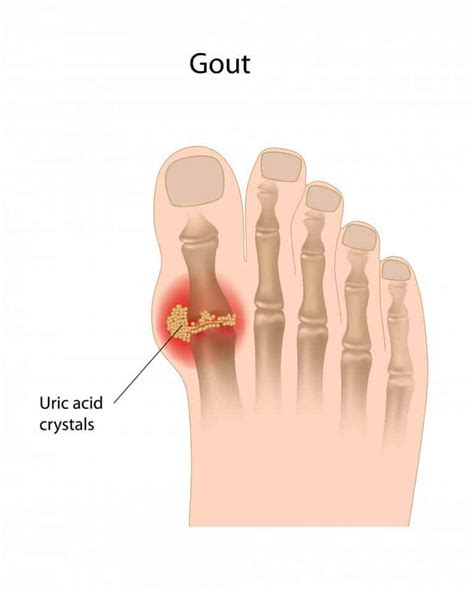 Gout, Red Hot Swollen Big Toe Joint - Beaver Valley Foot Clinic