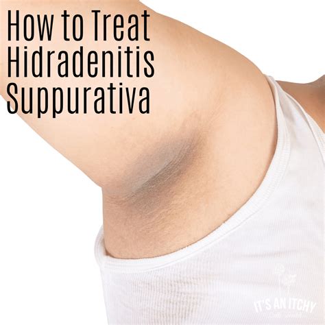 How to Treat Hidradenitis Suppurativa