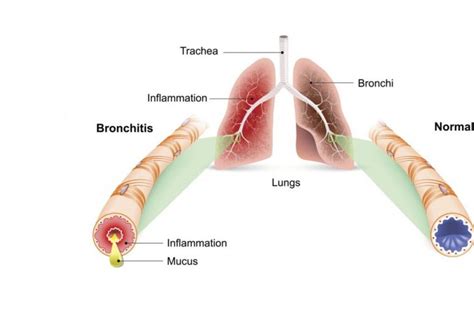 Causes of Bronchitis - Health & Detox & Vitamins