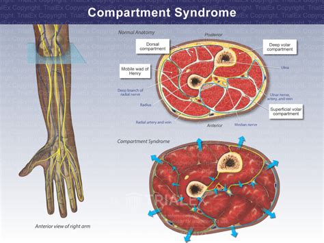 Compartment Syndrome - TrialQuest Inc.