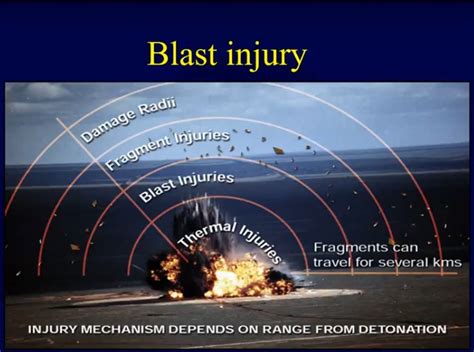 Orthopaedic Blast Injuries: Blast wave mechanics — OrthopaedicPrinciples.com