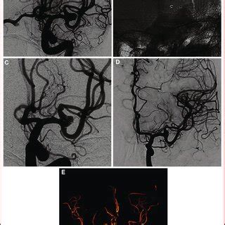 Unruptured MCA aneurysm (mean transverse diameter: 5.8 mm; mean height:... | Download Scientific ...