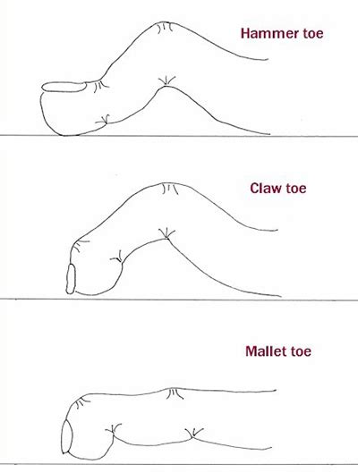 Flexor Tenotomy Surgey | Peter Rosenfeld FRCS, London